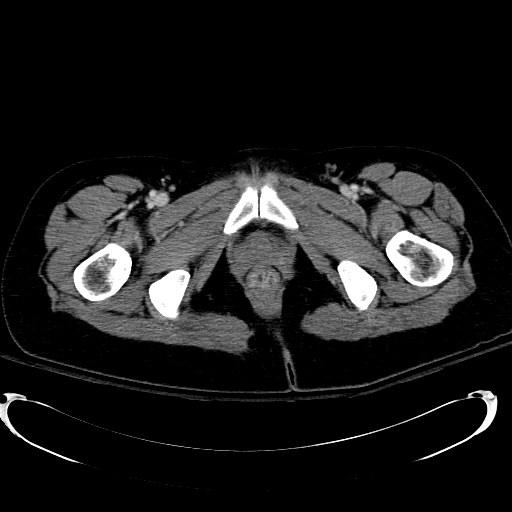 File:Acute myocardial infarction in CT (Radiopaedia 39947-42415 Axial C+ portal venous phase 141).jpg
