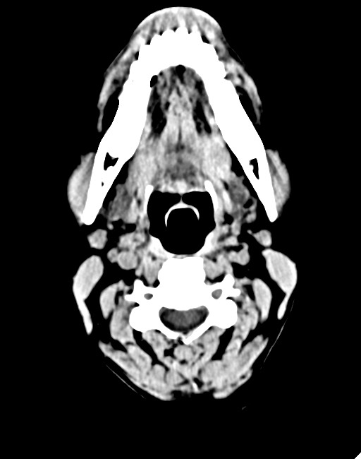 Acute on chronic subdural hematoma (Radiopaedia 74814-85823 Axial non-contrast 10).jpg
