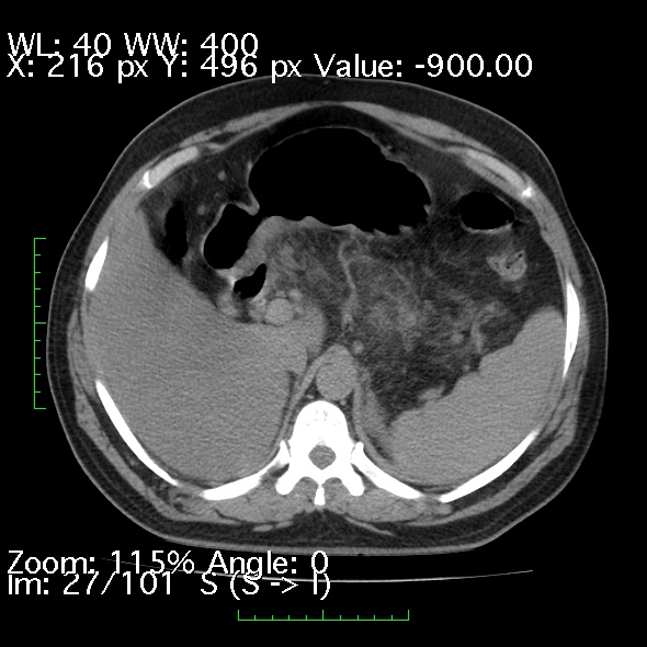 Acute pancreatitis (Radiopaedia 34043-35276 Axial non-contrast 27).jpg