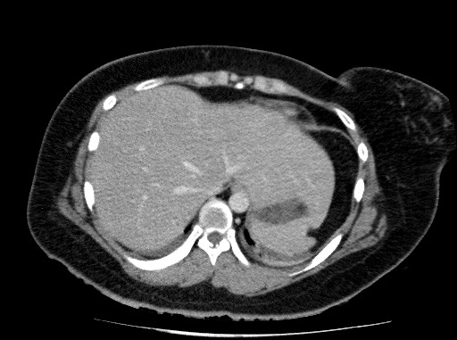 Acute pancreatitis (Radiopaedia 69236-79012 Axial C+ portal venous phase 14).jpg