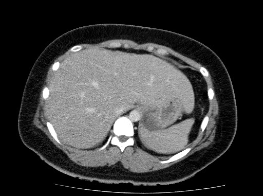 File:Acute pancreatitis (Radiopaedia 69236-79012 Axial C+ portal venous phase 18).jpg