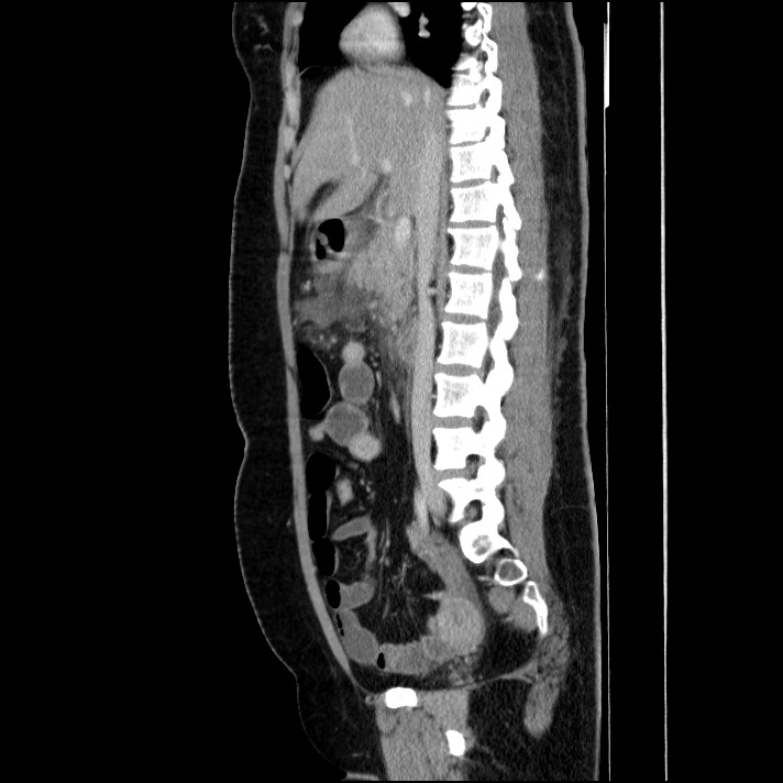 Acute pancreatitis (Radiopaedia 69236-79012 Sagittal C+ portal venous phase 58).jpg