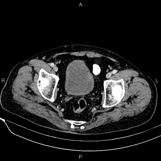 Acute pancreatitis (Radiopaedia 85146-100701 Axial C+ portal venous phase 58).jpg