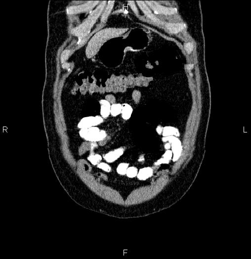 Acute pancreatitis (Radiopaedia 85390-101010 Coronal C+ portal venous phase 5).jpg