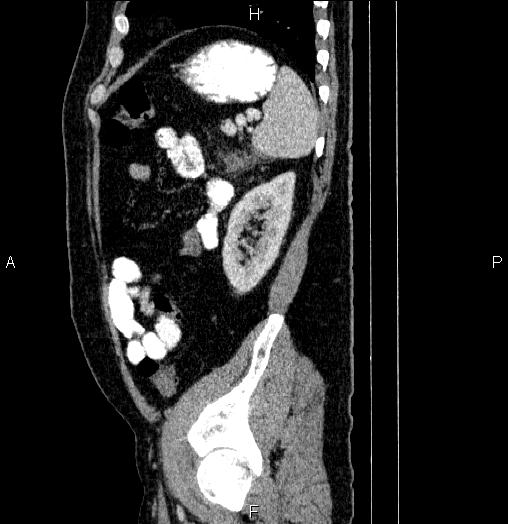 Acute pancreatitis (Radiopaedia 85390-101010 Sagittal C+ portal venous phase 82).jpg