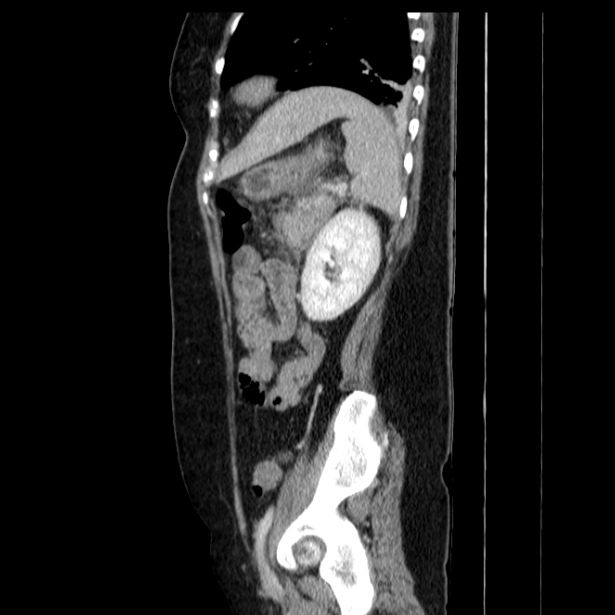 Acute pancreatitis - Balthazar C (Radiopaedia 26569-26714 Sagittal C+ portal venous phase 50).jpg