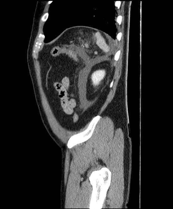Acute pancreatitis - Balthazar E (Radiopaedia 23080-23110 Sagittal C+ portal venous phase 87).jpg