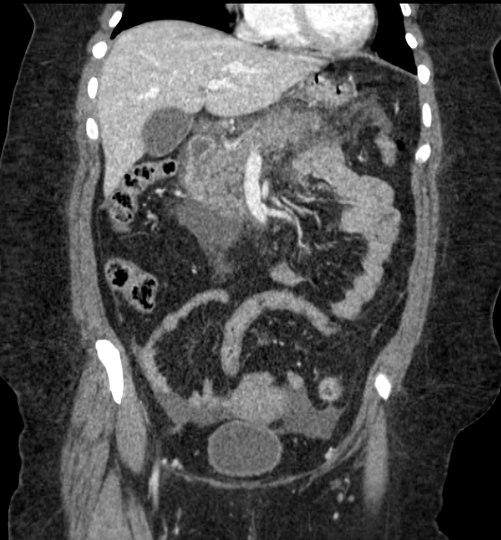Acute pancreatitis - Balthazar E (Radiopaedia 29016-29377 Coronal C+ portal venous phase 40).png