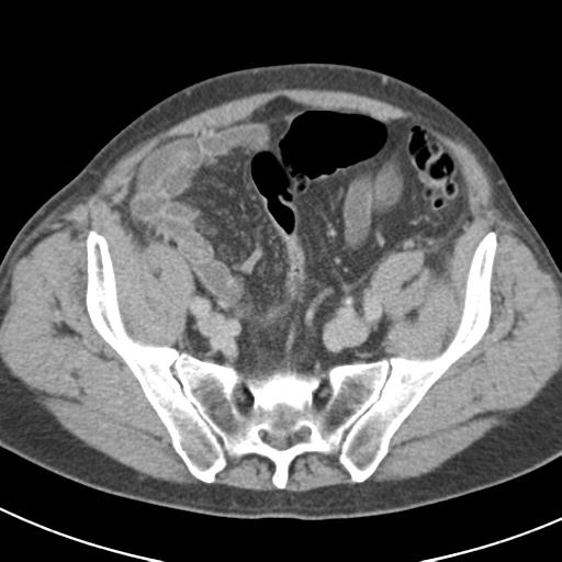 Acute pancreatitis and walled-off necrosis (Radiopaedia 29888-30403 Axial C+ delayed 66).jpg