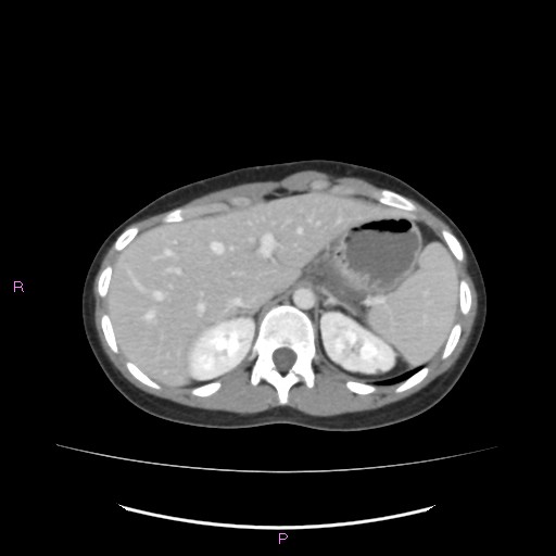 Acute pancreatitis secondary to stone at minor papilla and pancreatic divisum (Radiopaedia 76570-88333 Axial C+ portal venous phase 18).jpg