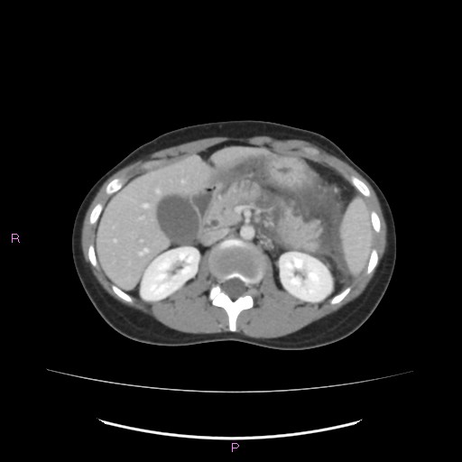 Acute pancreatitis secondary to stone at minor papilla and pancreatic divisum (Radiopaedia 76570-88333 Axial C+ portal venous phase 29).jpg