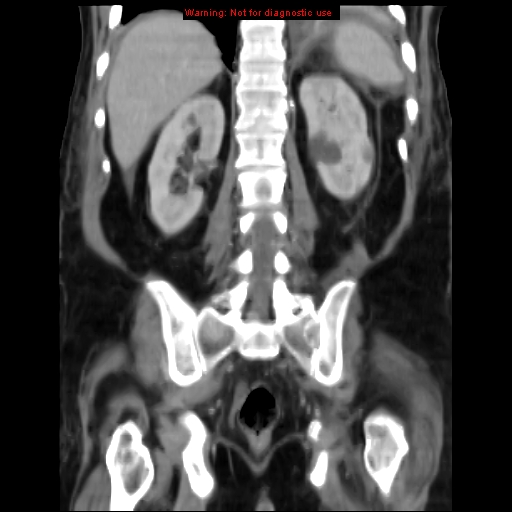 Acute pancreatitis with incidental pancreatic lipoma (Radiopaedia 10190-10730 Coronal C+ portal venous phase 54).jpg