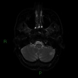 Acute posterior cerebral artery territory infarct (Radiopaedia 79329-92394 Axial DWI 34).jpg