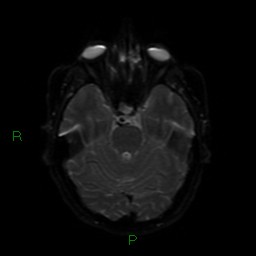 File:Acute posterior cerebral artery territory infarct (Radiopaedia 79329-92394 Axial DWI 38).jpg