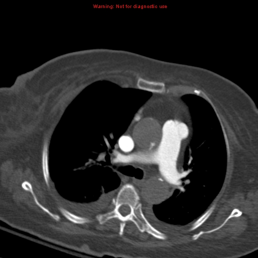File:Acute pulmonary embolism (Radiopaedia 13286-13289 Axial C+ CTPA 28).jpg