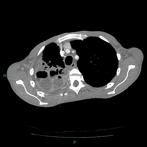 File:Acute right lung abscess (Radiopaedia 34806-36258 Axial C+ arterial phase 42).jpg