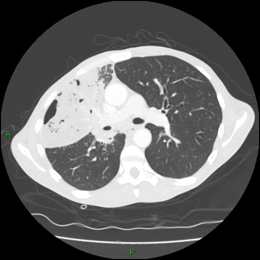 Acute right lung abscess (Radiopaedia 34806-36258 Axial lung window 81).jpg