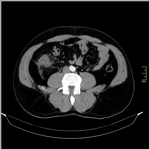 Acute right sided diverticulitis (Radiopaedia 65249-74268 Axial C+ portal venous phase 46).JPG