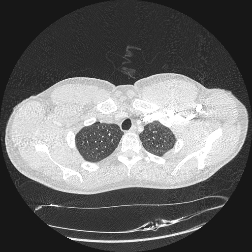 File:Acute segmental pulmonary emboli and pulmonary infarction (Radiopaedia 62264-70444 Axial lung window 19).jpg