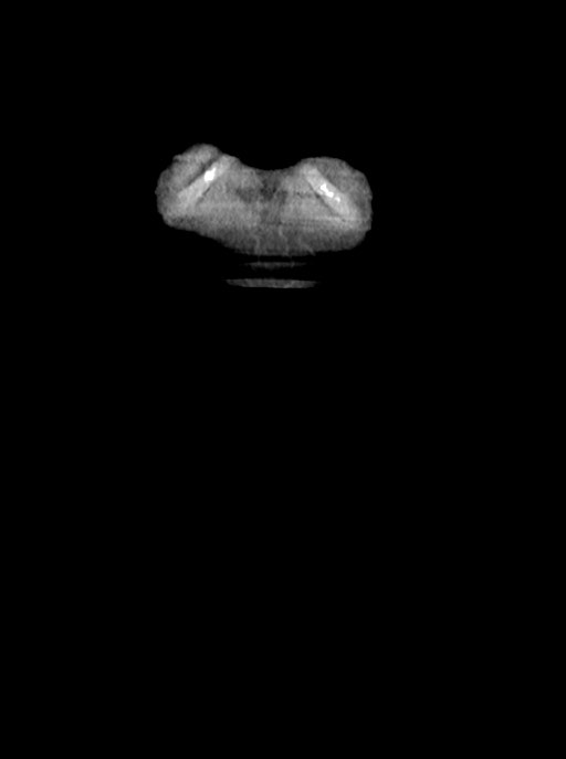 Acute small bowel (ileal) volvulus (Radiopaedia 71740-82139 Coronal C+ portal venous phase 4).jpg