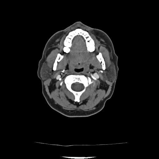 Acute subarachnoid hemorrhage and accessory anterior cerebral artery (Radiopaedia 69231-79009 Axial C+ arterial phase 65).jpg