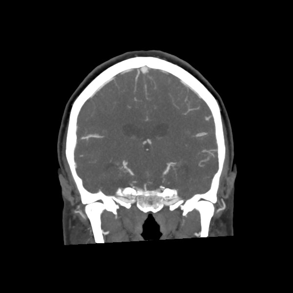 Acute subarachnoid hemorrhage and accessory anterior cerebral artery (Radiopaedia 69231-79009 Coronal C+ arterial phase 46).jpg