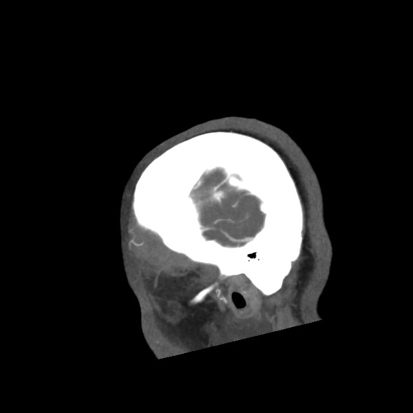File:Acute subarachnoid hemorrhage and accessory anterior cerebral artery (Radiopaedia 69231-79009 Sagittal C+ arterial phase 9).jpg
