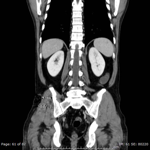 Acute superior mesenteric artery occlusion (Radiopaedia 43636-47060 Coronal C+ portal venous phase 46).jpg