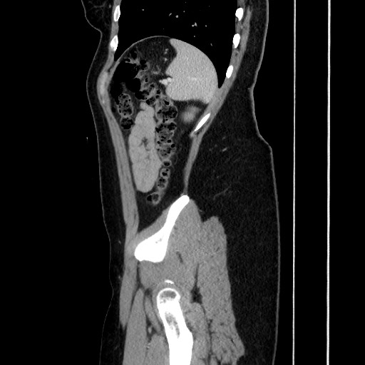 Acute uncomplicated appendicitis (Radiopaedia 73704-84499 Sagittal C+ portal venous phase 160).jpg