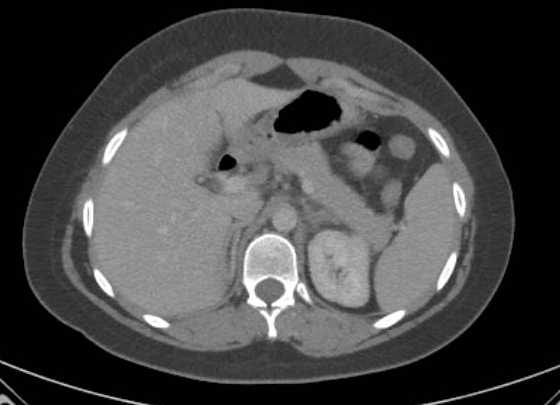 Acute unilateral nonhemorrhagic adrenal infarction (Radiopaedia 67560-76957 Axial renal parenchymal phase 30).jpg