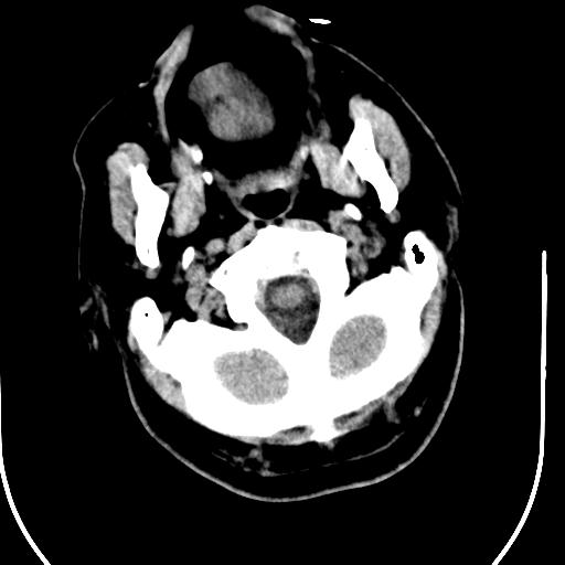 File:Acute vertebrobasilar ischemic infarction (Radiopaedia 25220-25473 Axial non-contrast 6).jpg