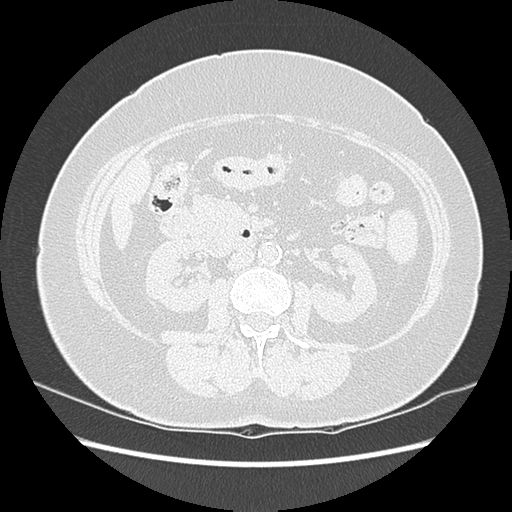 Adenocarcinoma in situ of lung (Radiopaedia 38685-40829 B 265).png