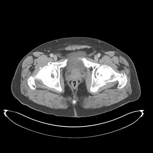 File:Adenocarcioma of rectum- T1 lesion (Radiopaedia 36921-38547 Axial C+ portal venous phase 86).png