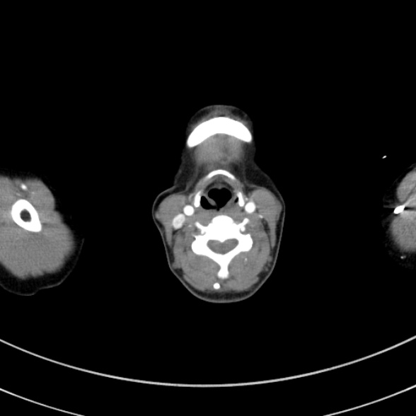 Adenocystic carcinoma of the trachea (Radiopaedia 47677-52525 Axial C+ arterial phase 18).jpg