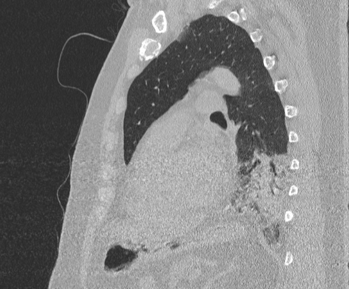 Adenoid cystic carcinoma of the trachea (Radiopaedia 49042-54137 Sagittal lung window 294).jpg