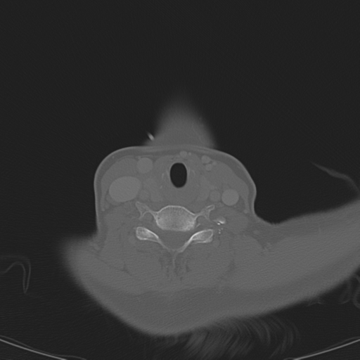 Adenoid cystic tumor of palate (Radiopaedia 46980-51518 Axial bone window 53).png