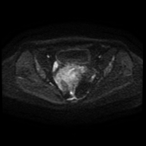 Adenoma malignum of cervix (Radiopaedia 66441-75705 Axial DWI 86).jpg