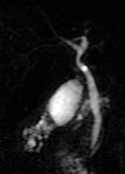 File:Adenomyomatosis of the gallbladder - MRCP (Radiopaedia 13695).jpg