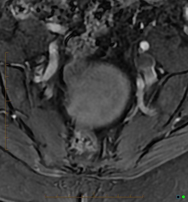 Adenomyosis uterus with hematometra (Radiopaedia 45779-50011 Axial T1 C+ fat sat 4).jpg