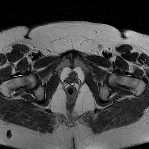 File:Adenomyosis within a didelphys uterus (Radiopaedia 70175-80215 Axial T2 31).jpg