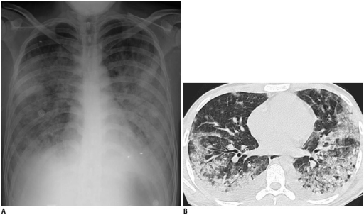 File:Adenovirus pneumonia CT-scan 1.png