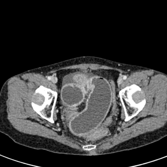 File:Adhesional small bowel obstruction (Radiopaedia 48397-53305 Axial C+ portal venous phase 84).jpg