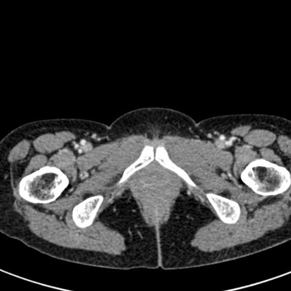 File:Adhesional small bowel obstruction (Radiopaedia 48397-53305 Axial C+ portal venous phase 99).jpg