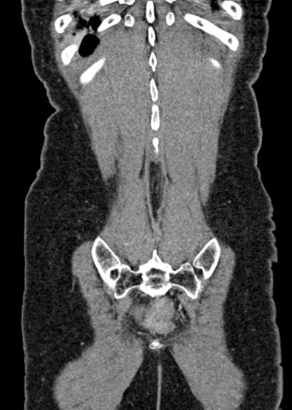 Adhesional small bowel obstruction (Radiopaedia 48397-53305 Coronal C+ portal venous phase 314).jpg