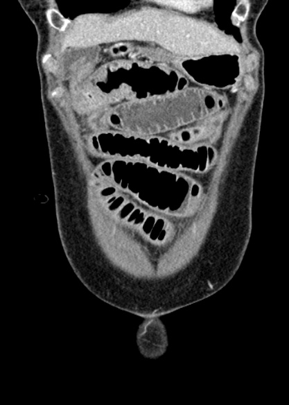 Adhesional small bowel obstruction (Radiopaedia 48397-53305 Coronal C+ portal venous phase 60).jpg