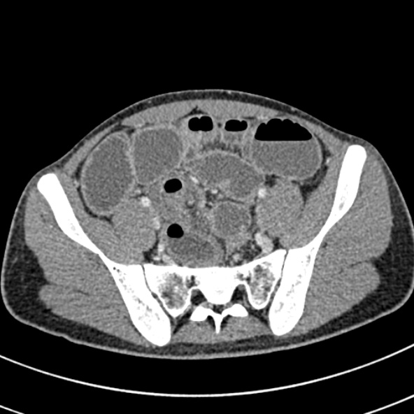 Adhesional small bowel obstruction (Radiopaedia 52107-57980 Axial C+ portal venous phase 98).jpg