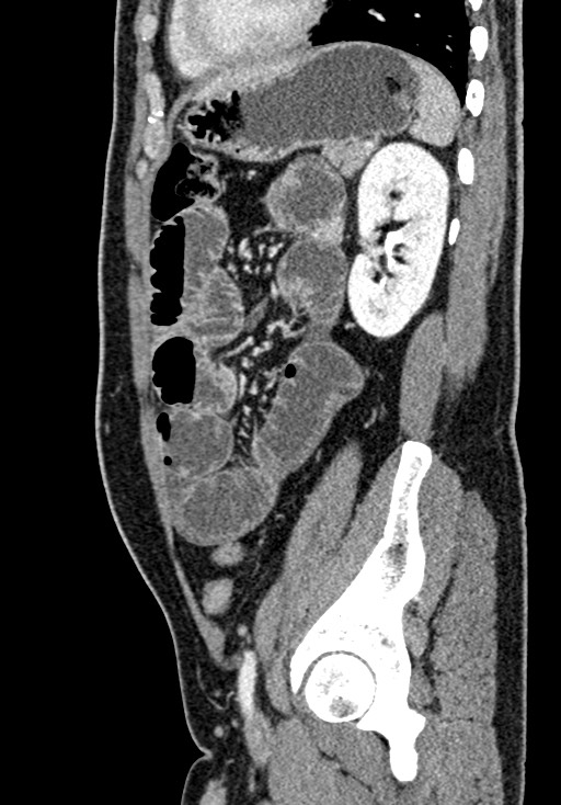 Adhesional small bowel obstruction (Radiopaedia 58900-66131 Sagittal C+ portal venous phase 180).jpg
