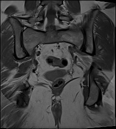 File:Adnexal multilocular cyst (O-RADS US 3- O-RADS MRI 3) (Radiopaedia 87426-103754 Coronal 24).jpg