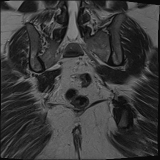 File:Adnexal multilocular cyst (O-RADS US 3- O-RADS MRI 3) (Radiopaedia 87426-103754 Coronal T2 26).jpg