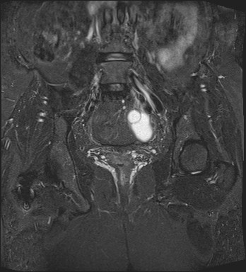 File:Adnexal multilocular cyst (O-RADS US 3- O-RADS MRI 3) (Radiopaedia 87426-103754 Coronal T2 fat sat 19).jpg